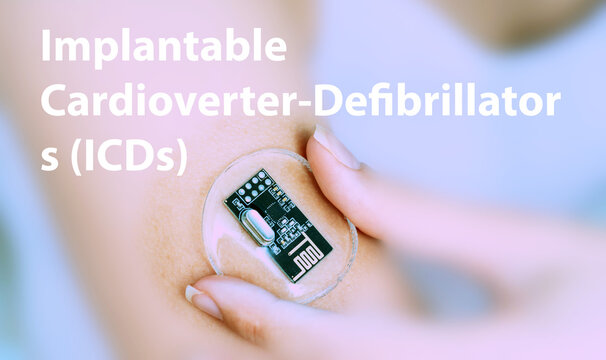 Implantable Cardioverter-Defibrillators (ICDs) Implantable Electronic