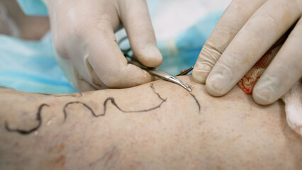 The male hands of a doctor do an operation on the veins, on the patient's leg. Preparation of the...