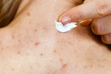 Woman with pimple on back applying medical ointmeny