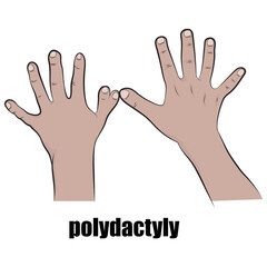 Polydactyly, a condition in which a person has more than the normal number of fingers or toes.