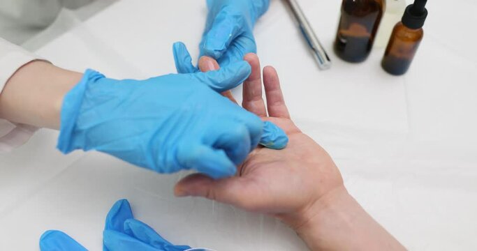 Doctor cosmetologist applies healing ointment to treat patient hand. Skin treatment and psoriasis