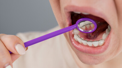 Close-up portrait of a woman with internal braces and a dental mirror. The girl corrects the bite