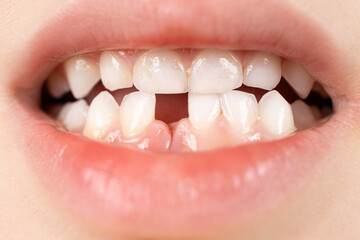 Loss of milk teeth in children. A six-year-old child shows the first baby tooth that has fallen out