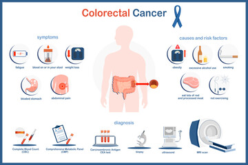 Vector infographic illustration of colon cancer. Medical illustration concept. Colon cancer symptoms, causes and Risk factors  and diagnosis of bowel cancer.flat style isolated on white background.