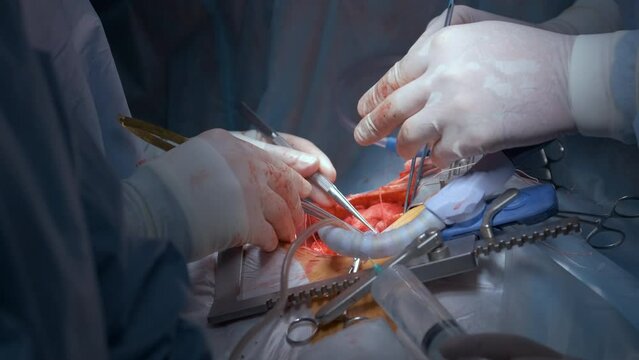 Team of professional doctors operating a patient conducting open heart surgery in surgical room. Healthcare and medical intervention concept