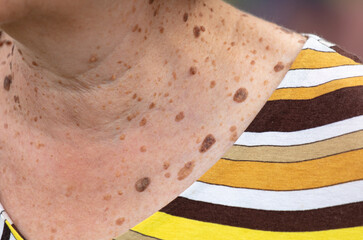 Moles and warts on the skin of a woman's neck