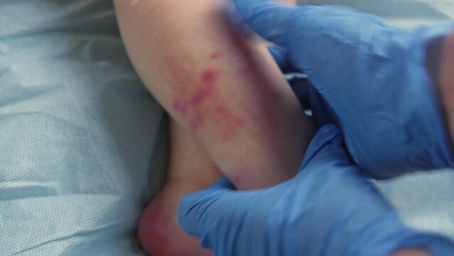 Doctor hands examining infant leg. Little Kid allergy. Closeup. Child scratches a red rash. Nurse applies a special cream to atopic skin. Dermatitis, diathesis, irritation on the baby body. Pruritus	
