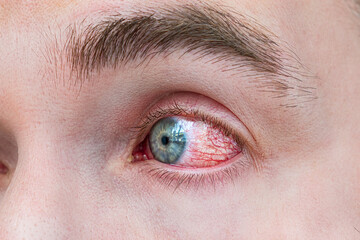 Man with red eye, macro shot. Conjunctivitis infection. concept of eye disease, Allergic...