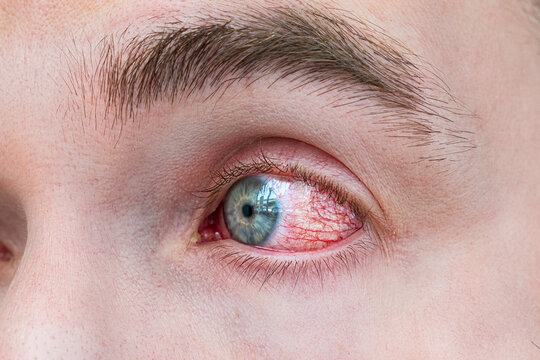 Man with red eye, macro shot. Conjunctivitis infection. concept of eye disease, Allergic conjunctivitis hyperemia
