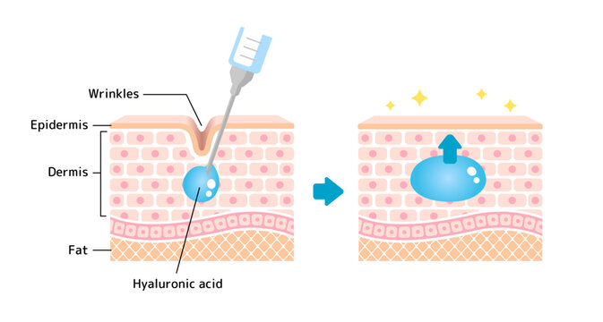 Mechanism illustration of hyaluronic acid injection (cross-sectional view of the skin)