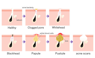 ニキビの進行がわかるシンプルな説明イラスト