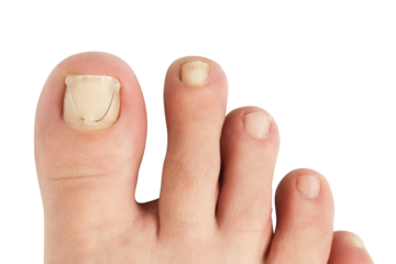 Titanium thread on the nail of the big toe. Ingrown toenail treatment