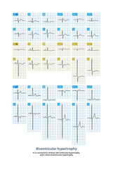 The electrocardiogram of biventricular hypertrophy can be completely normal, with unilateral ventricular hypertrophy or bilateral ventricular hypertrophy simultaneously.