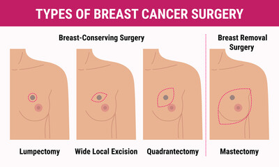 Types of breast cancer surgery lumpectomy, quadrantectomy, mastectomy. Medical illustration of women s chest with scar after surgery. Breast Cancer Awareness Month. Women health care - obrazy, fototapety, plakaty