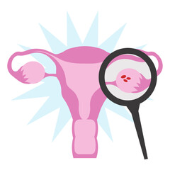 uterus ovaries pcos magnifying glass in flat illustration - obrazy, fototapety, plakaty