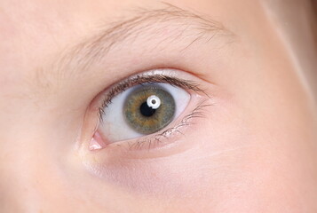 Wide open child's eye with an eyebrow and moles on skin. Visual examination in children