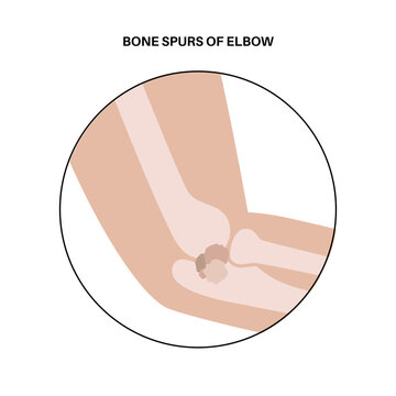 Bone spurs of elbow