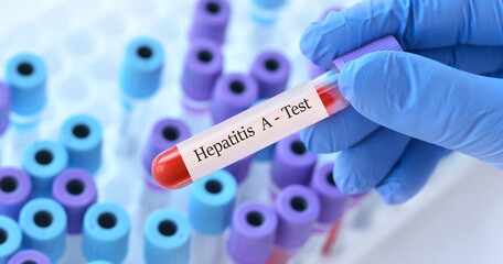 Fototapeta premium The doctor holds a test blood sample tube with hepatitis A virus (HAV) test on the background of medical test tubes