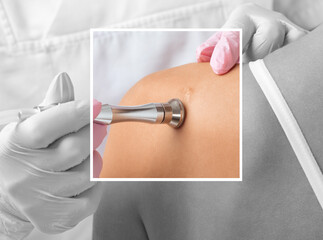 A beautician does a microdermabrasion procedure in a beauty salon, removing a scar on the shoulder....