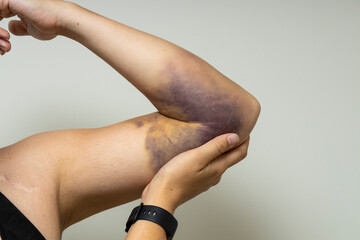 Supporting an arm with a significant bruise.