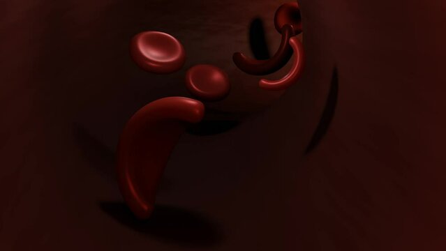 sickle cell anemia flowing inside of blood vessel, some red blood cells look like sickles 3d rendering	
