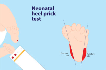 Neonatal heel prick test illustration. Newborn foot with blood and the test paper And foot illustration with the correct puncture site - obrazy, fototapety, plakaty
