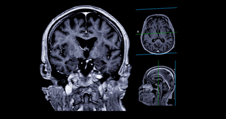 MRI  brain scan Axial , Coronal and sagittal view with referance line for detect  Brain  diseases...
