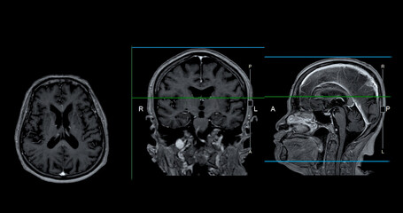 MRI  brain scan Axial , Coronal and sagittal view with referance line for detect  Brain  diseases...
