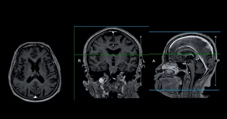 Fotobehang MRI  brain scan Axial , Coronal and sagittal view with referance line for detect  Brain  diseases sush as stroke disease, Brain tumors and Infections. © samunella