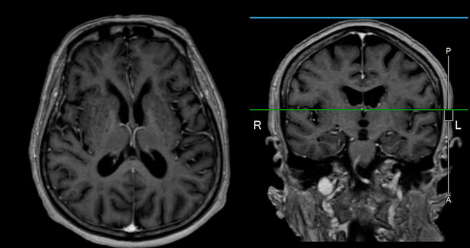 MRI  brain scan  for detect  Brain  diseases sush as stroke disease, Brain tumors and Infections.