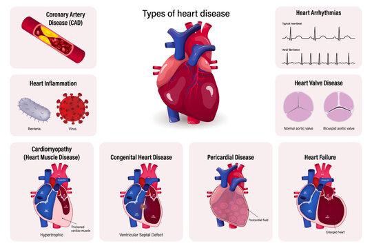 Types of heart disease vector. Coronary Artery
Disease (CAD), Heart Inflammation, Cardiomyopathy, Congenital Heart Disease, Pericarditis, Heart Failure, Heart Valve and Cardiac Arrhythmias.