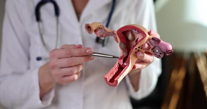 Doctor is holding model of uterus and ovaries. Ovarian and cervical cancer and cervical disorder