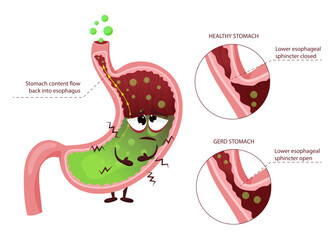 Gastroesophageal reflux disease GERD diagram with sad stomach cartoon character. Moving gastric juice to esophagus through opened esophageal sphincter, making heartburn. Detailed vector illustration