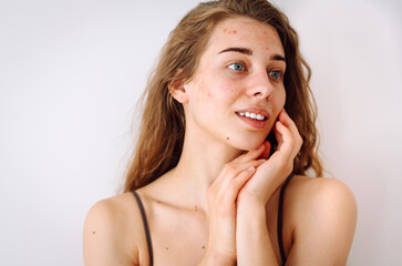 Close-up portrait of a beautiful woman without makeup with imperfect skin. Acne skin. Natural...