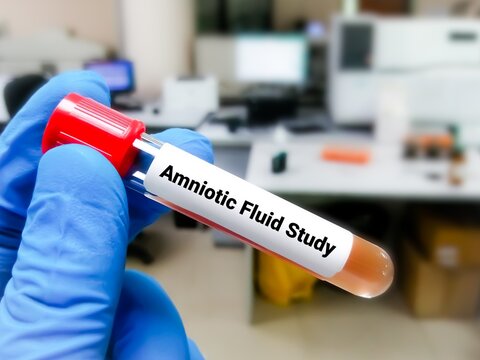 Amniocentesis (amniotic fluid test) a test done during pregnancy (15 to 20 weeks) to diagnose certain genetic disorders, birth defects and other conditions in an unborn baby.