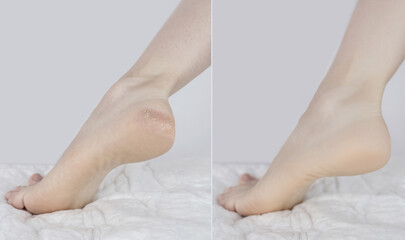 Cracked heels. Woman feet before and after procedures to soften rough skin. Urea cream, oil for care of keratinized skin, healing of cracked foot. Usage foot grater, cream with urea, softening oil.