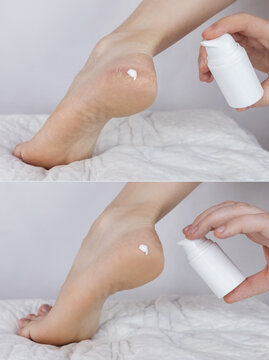Cracked heels. Woman feet before and after procedures to soften rough skin. Urea cream, oil for care of keratinized skin, healing of cracked foot. Usage foot grater, cream with urea, softening oil.