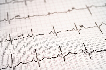 Electrocardiogram ECG, heart wave, heart attack, cardiogram report.