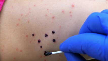 Chickenpox Blisters Lubricated with Antiseptic Drug with Cotton Swab