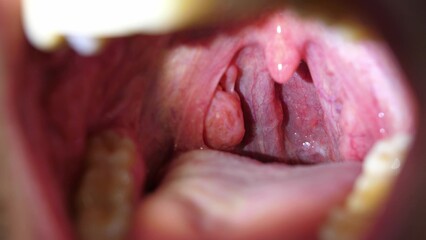 Patient With Sore Throat Examination of Strep Throat and Adenoids