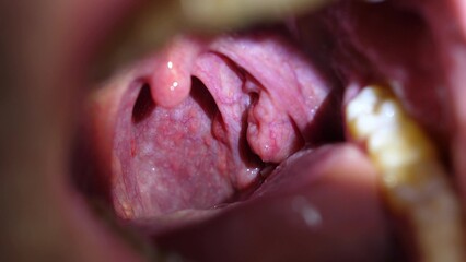 Patient With Sore Throat Examination of Strep Throat and Adenoids