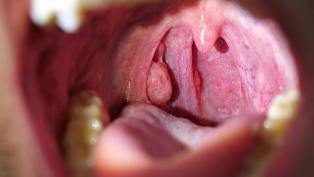 Patient With Sore Throat Examination of Strep Throat and Adenoids
