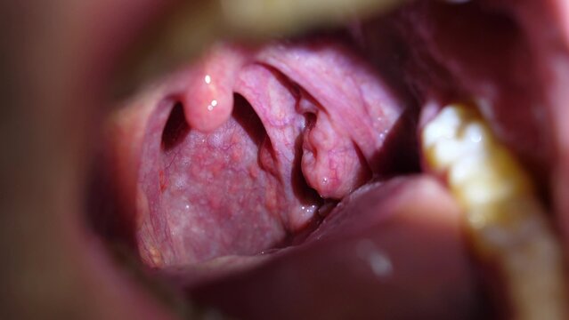 Patient With Sore Throat Examination of Strep Throat and Adenoids