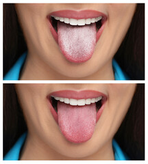 Collage with photos of woman before and after tongue cleaning, closeup