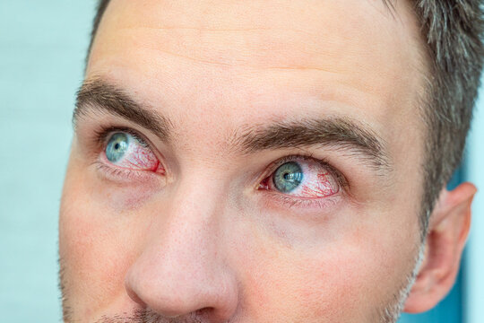 Closeup of two annoyed red blood eyes of male affected by conjunctivitis or after fly, color allergy. Concept of health, disease and treatment.