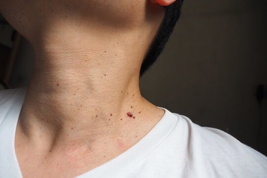 Many skin tags or Acrochordon on the neck of an Asian male. They are small soft and common benign on the human skin especially on adult skin and can be irritated by shaving and daily clothing