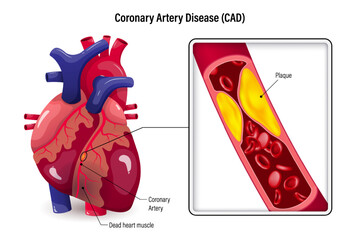 Coronary artery disease vector. CAD that caused by atherosclerosis. Cholesterol in blood vessels. Clogged arteries caused by cholesterol.