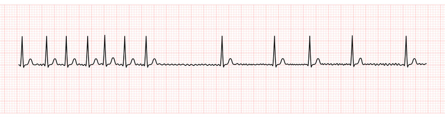 EKG Monitor Showing Atrial Fibrillation With Rapid Ventricular Response and Slower Rate After Adenosine Intravenous