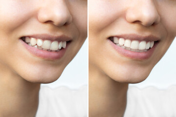 Young woman's smile before and after teeth straightening. Ideal, beautiful shape of teeth after...