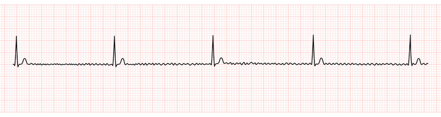 EKG Monitor Showing Regularized Atrial Fibrillation or AF with Block